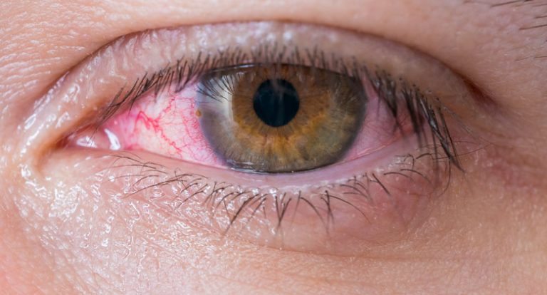 Cuidado Con La Conjuntivitis Viral Clínica Foscal